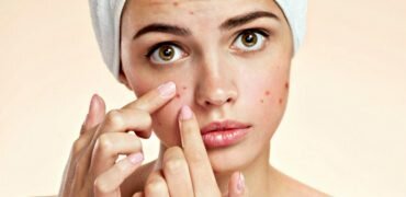piel-sin-acne